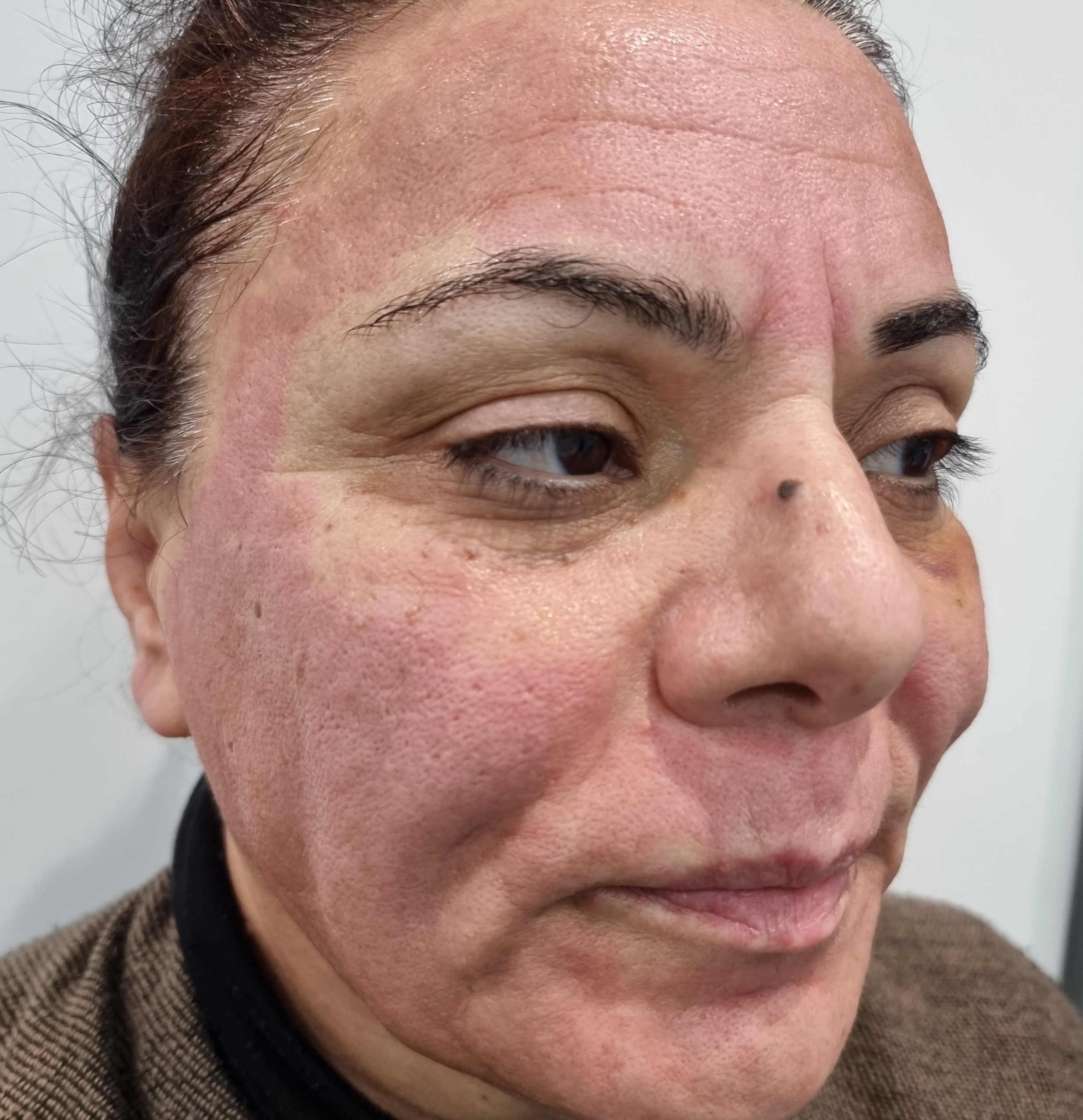 Laser Skin Resurfacing – Prity Skincare