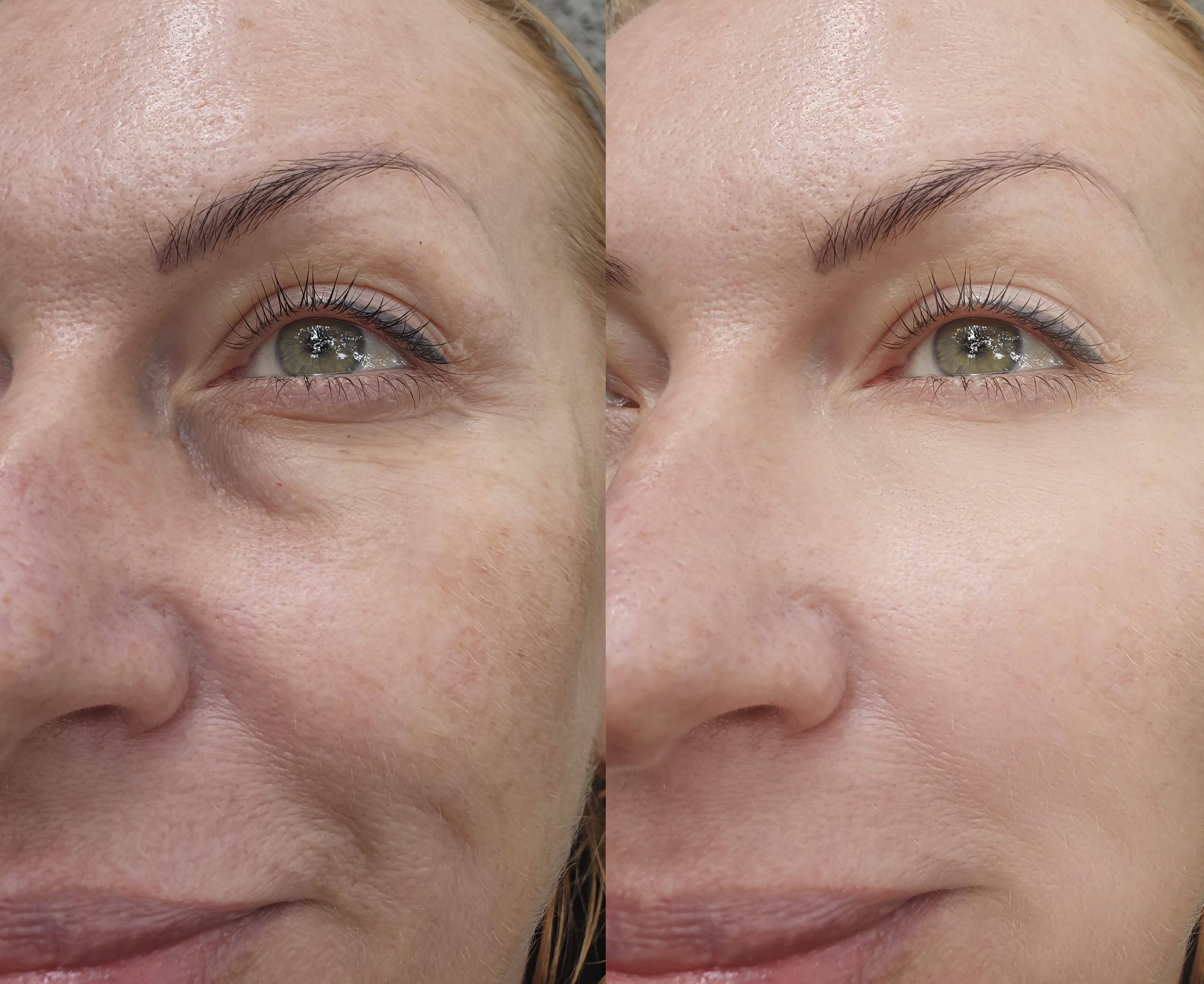 CO2 Laser Skin Resurfacing – Prity Skincare