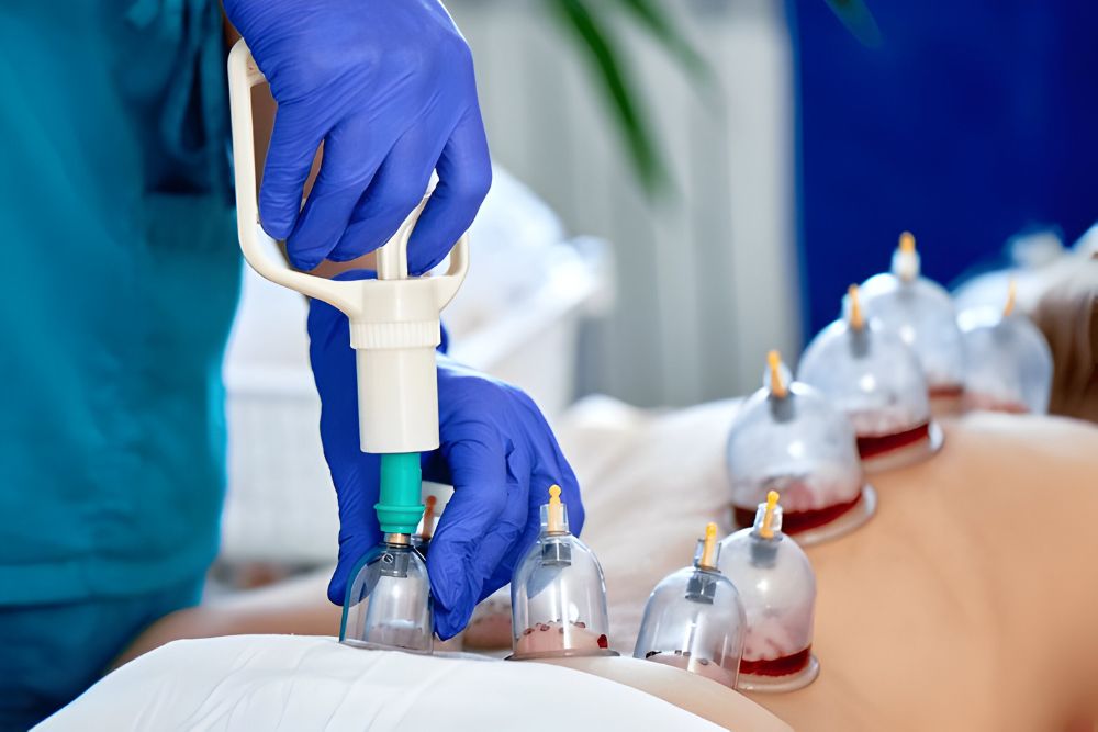 Hijama Therapy