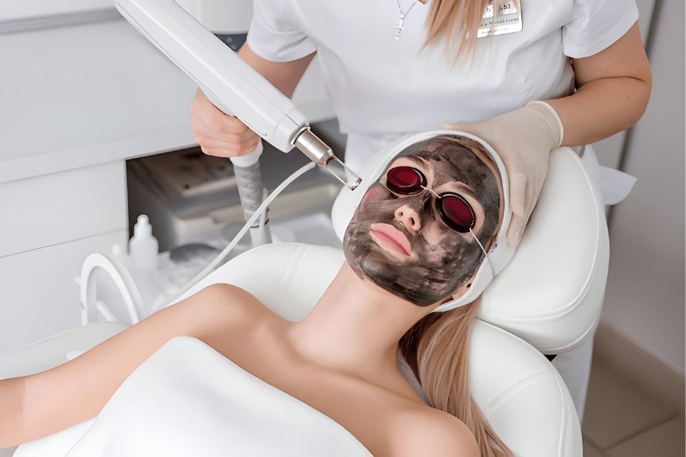 Carbon Laser Facial