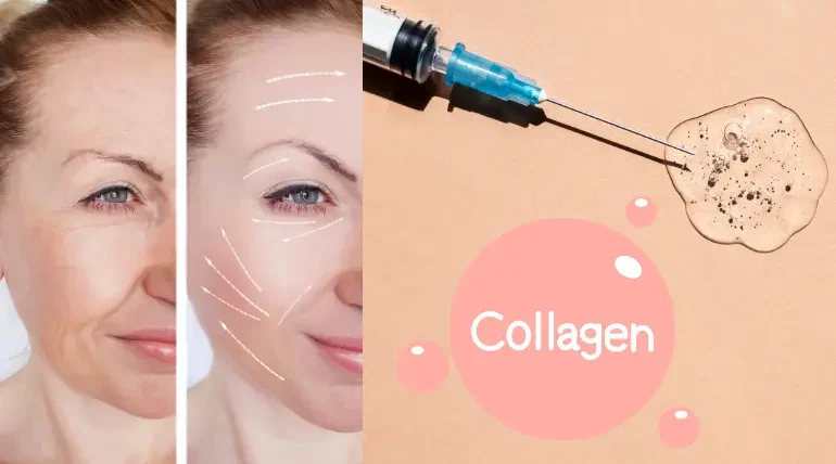 The Ultimate Guide to Collagen Injections for Radiant Skin